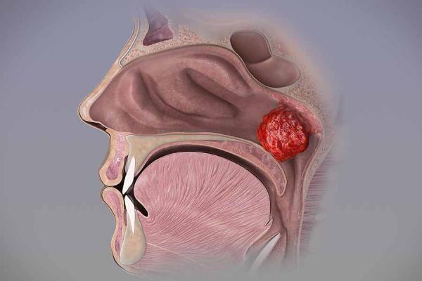 Adenoid Hypertrophy: known mistakes