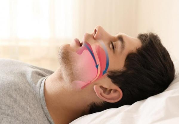 Sleep Apnea Treatment